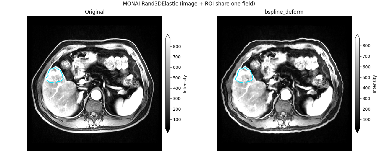 MONAI Rand3DElastic (image + ROI share one field), Original, bspline_deform