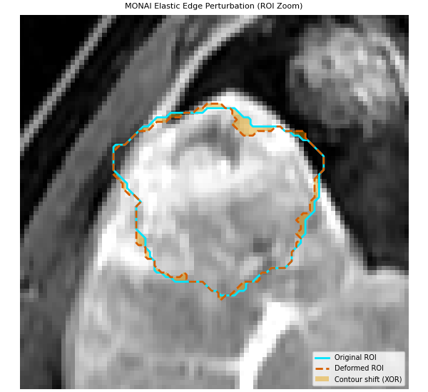 MONAI Elastic Edge Perturbation (ROI Zoom)