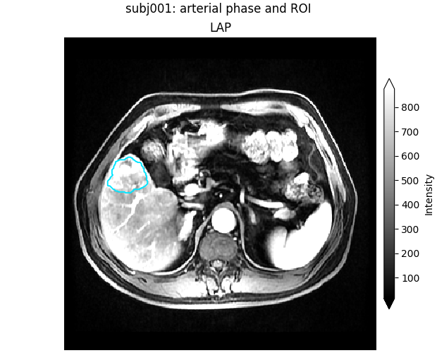 subj001: arterial phase and ROI, LAP